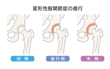 変形性股関節症の進行