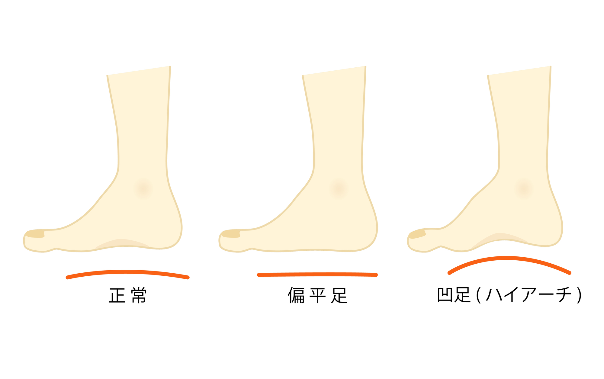 扁平足・開帳足は外反母趾になりやすい？