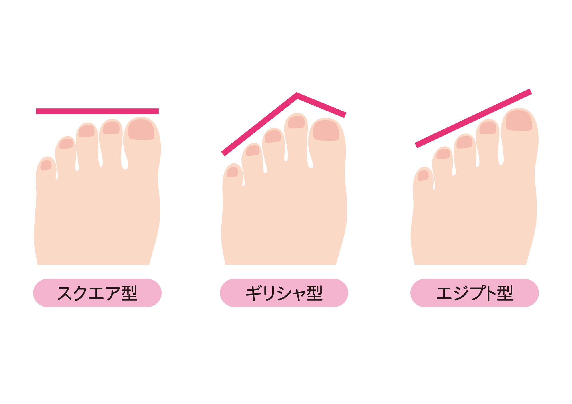 外反母趾になりやすい足の形